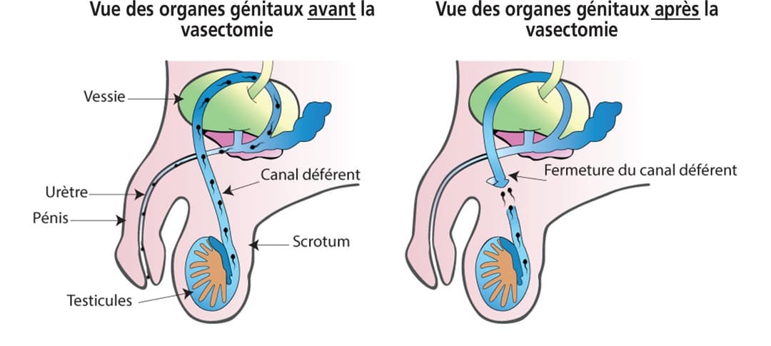 Illustration de la procédure de vasectomie